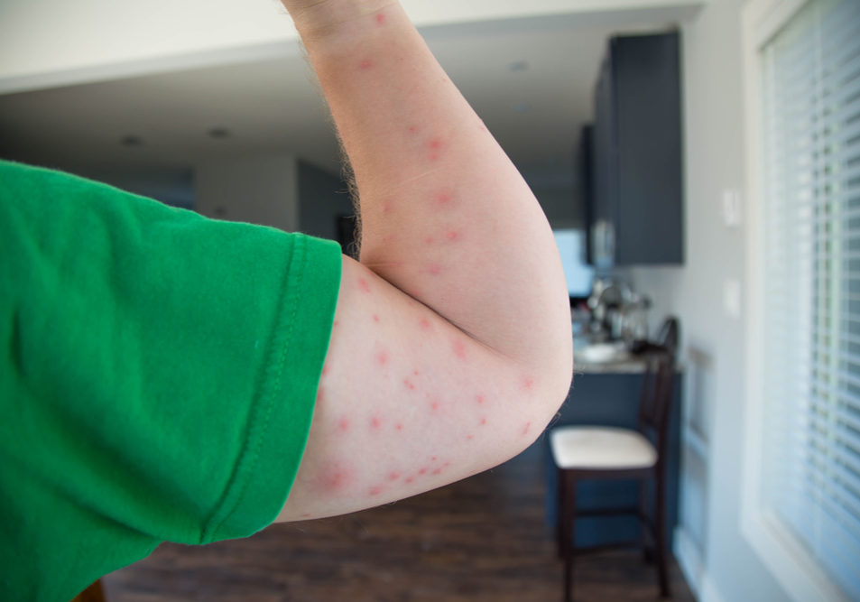 What To Do About Bed Bug Bites in Mississauga?